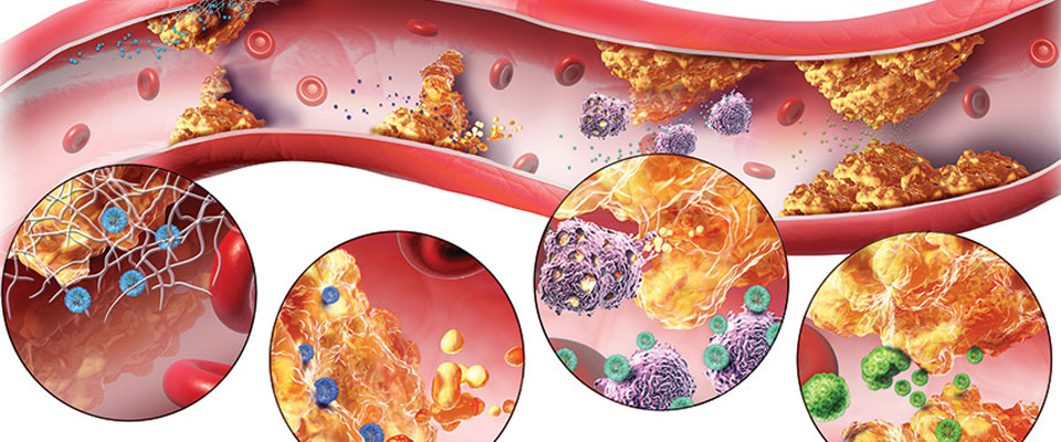 Atherosclerosis