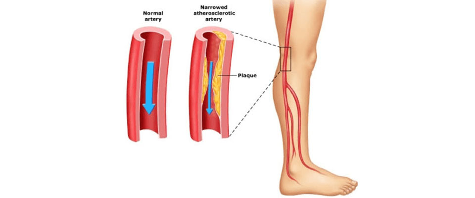 Intermittent Claudication
