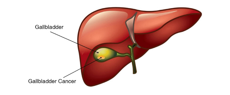 Gallbladder & Biliary Tract Surgery