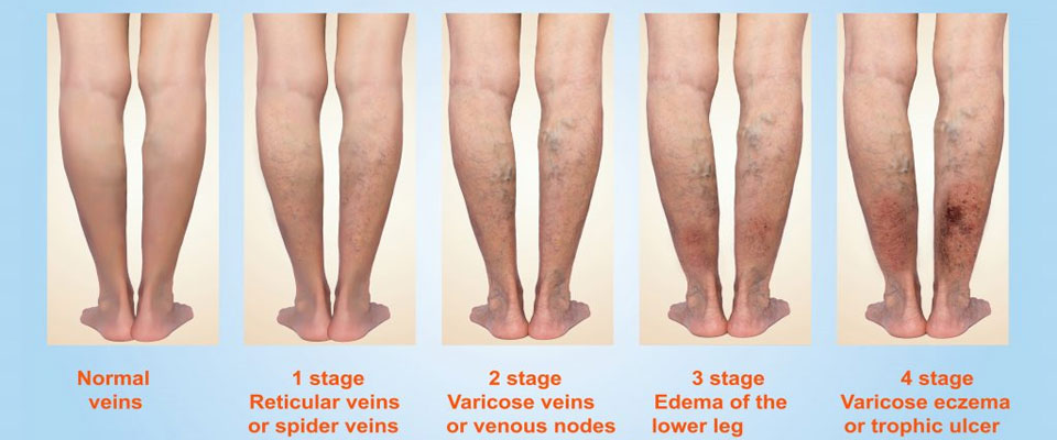 Leg Ulcers