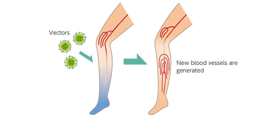 Lower Limb Ischemia