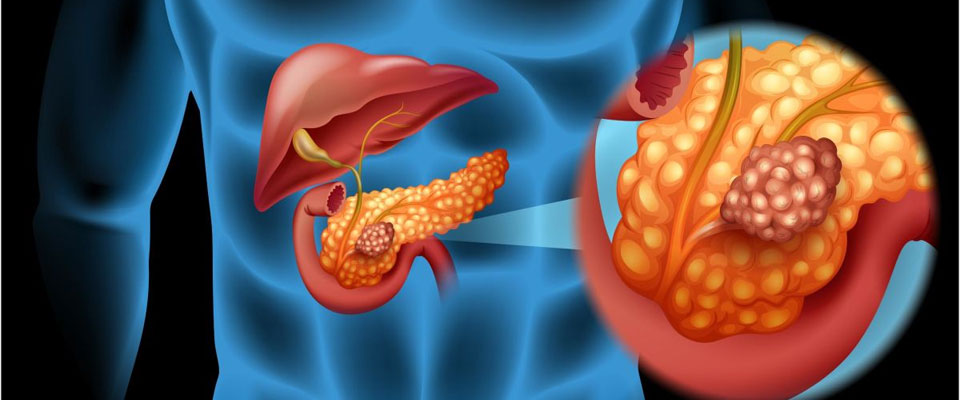 Pancreas Surgery