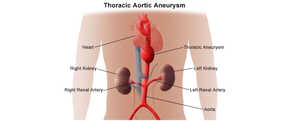 Thoracic Aneurysm