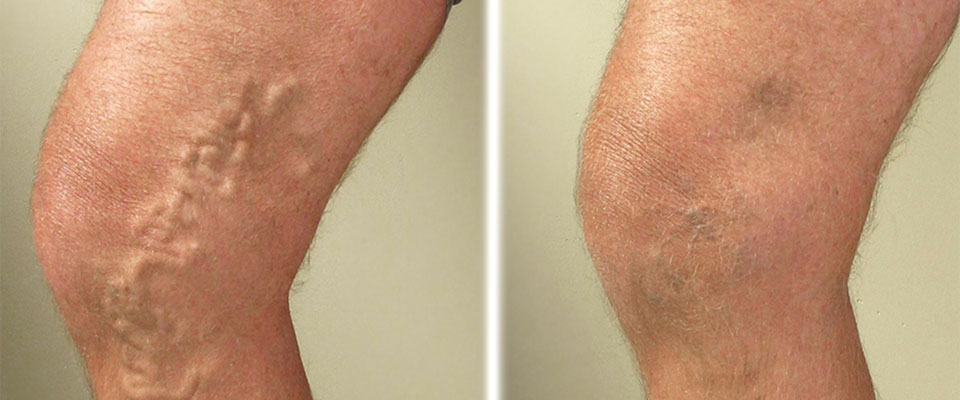 Thread Veins