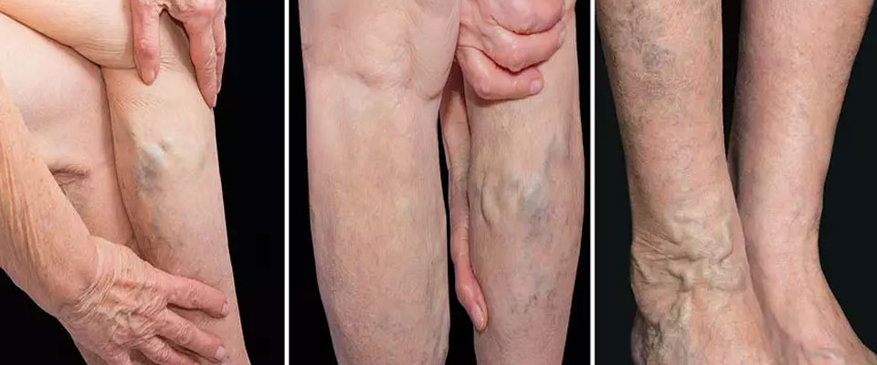 Varicose Vein